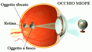 occhio-miope-con-immagine1-300x169